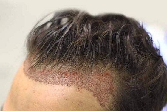 hair transplantation