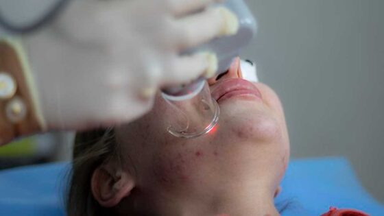 laser treatment 6664875 340 1