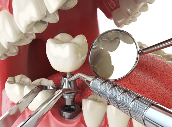 What can go wrong with zygomatic implants