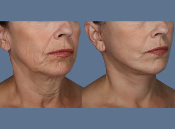 botched fat grafting face
