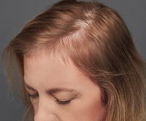 diffuse unpatterned alopecia